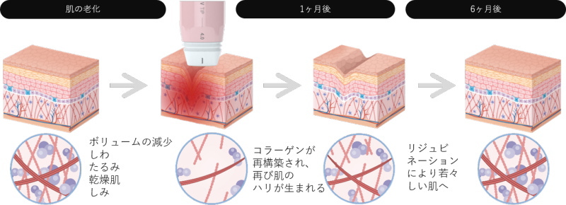 ボルニューマー効果